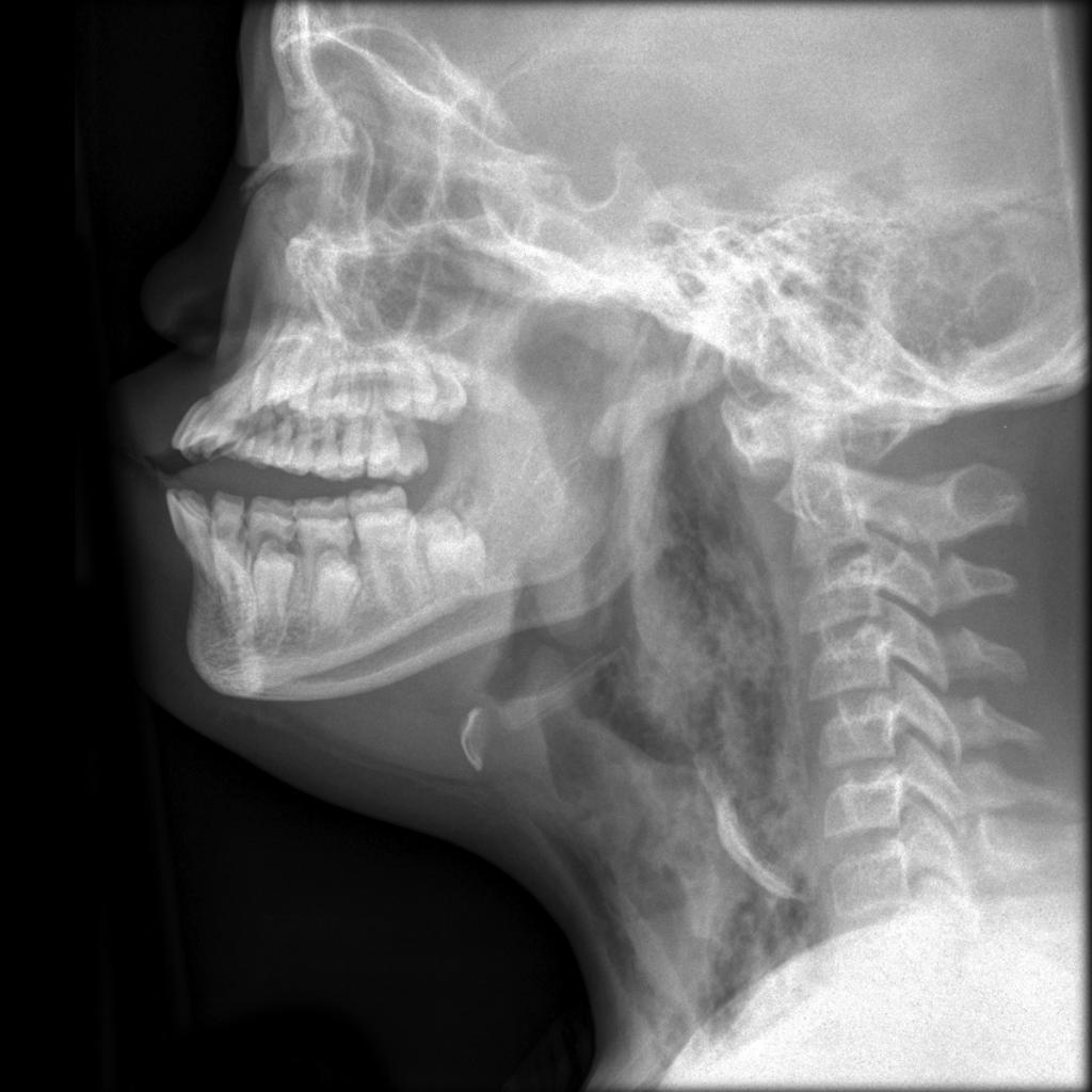 بررسی کلینیکی و تصویربرداری در مورد پارگی هیپوفارنکس/مری فوقانی ناشی از بلع جسم خارجی استخوانی