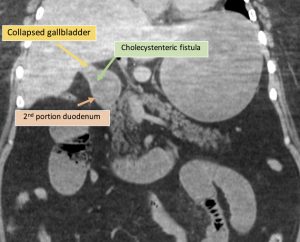 4 یافته مهم در تشخیص ایلئوس سنگ صفراوی در سی تی اسکن