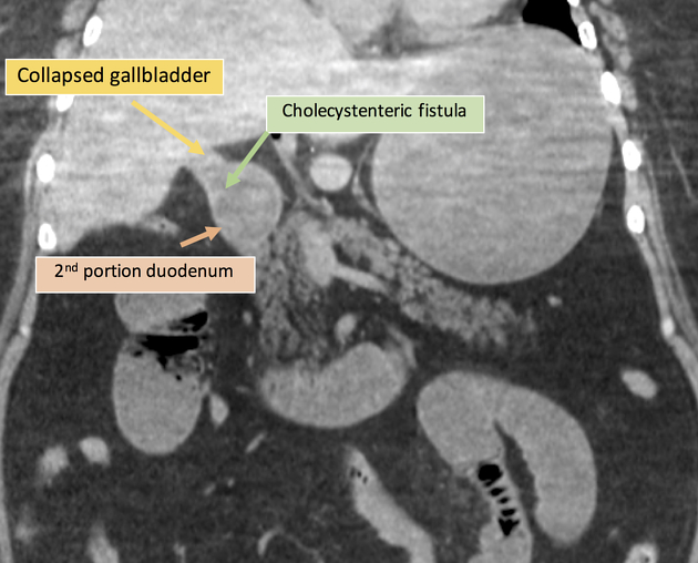 4 یافته مهم در تشخیص ایلئوس سنگ صفراوی در سی تی اسکن