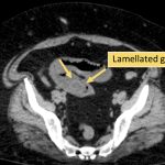 4 یافته مهم در تشخیص ایلئوس سنگ صفراوی در سی تی اسکن
