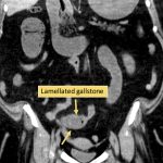 4 یافته مهم در تشخیص ایلئوس سنگ صفراوی در سی تی اسکن