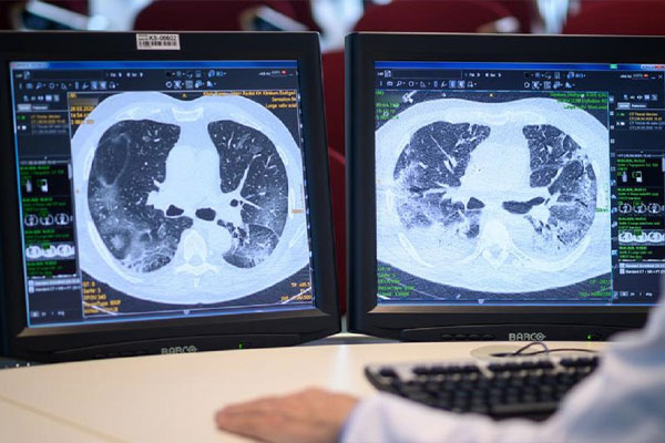 تفسیر سی تی اسکن ریه