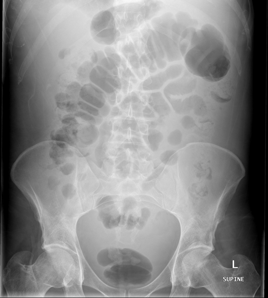 آسیت در رادیوگرافی و تشخیص آن