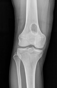 Non-ossifying fibroma
