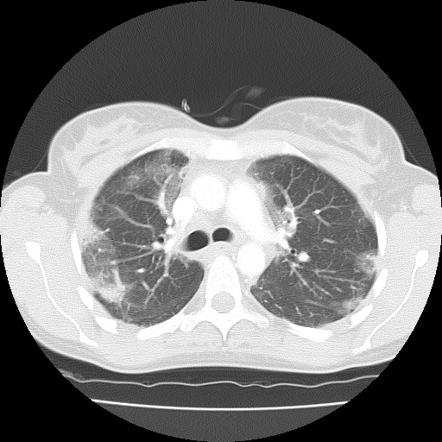 نمای ground-glass opacity (GGO) در سی تی اسکن ریه