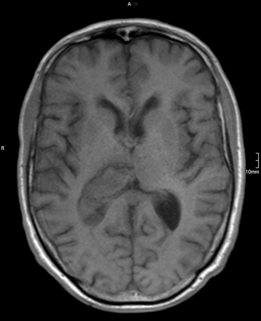 تشخیص خونریزی مغزی در MRI