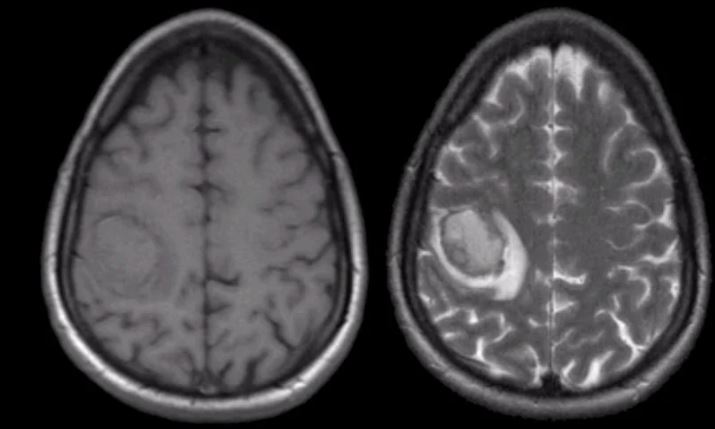 تشخیص خونریزی در MRI مغز