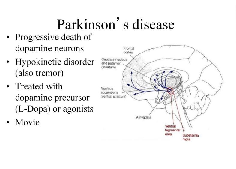 MRI مغز و نقش کلیدی آن در تشخیص پارکینسون: وقتی تجمع آهن حرف می‌زند